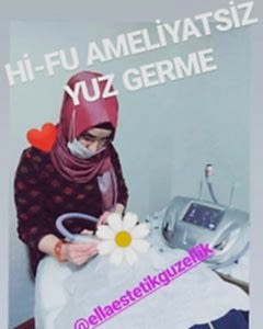 yüz germe