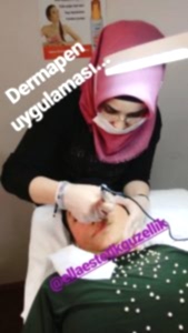 dermapen uygulaması