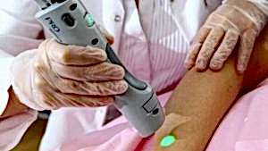 kalıcı dövme silme